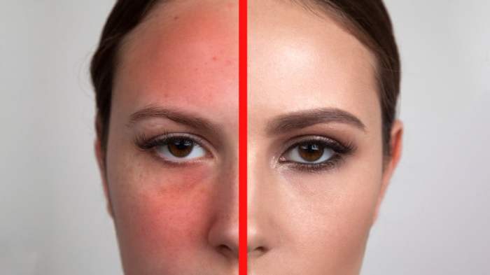 Redness exercise rid self exercising emily How to eliminate redness from face