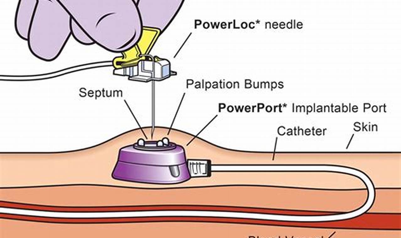 An Easy-to-Follow Guide on Accessing Your Port-A-Cath Safely and Effectively