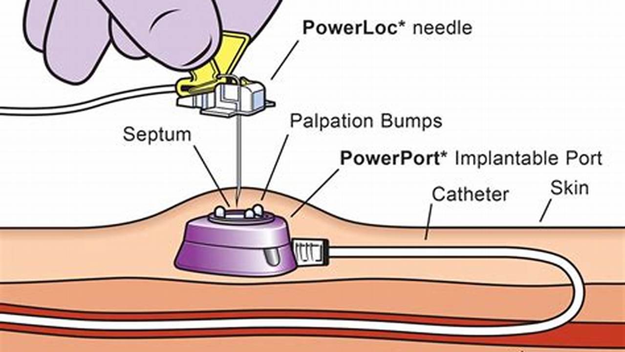 How To Access A Port A Cath