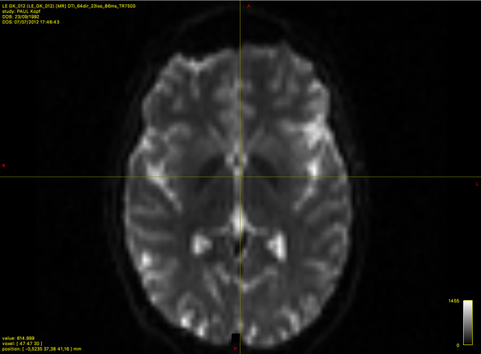 Mri diffusion registration 2m dti sift 1mm t1 tck Mri diffusion registration 2m dti sift 1mm t1 tck
