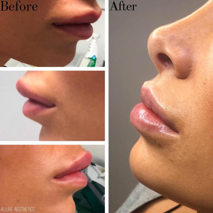 How Lengthy Does Filler Dissolve? Your Final Information