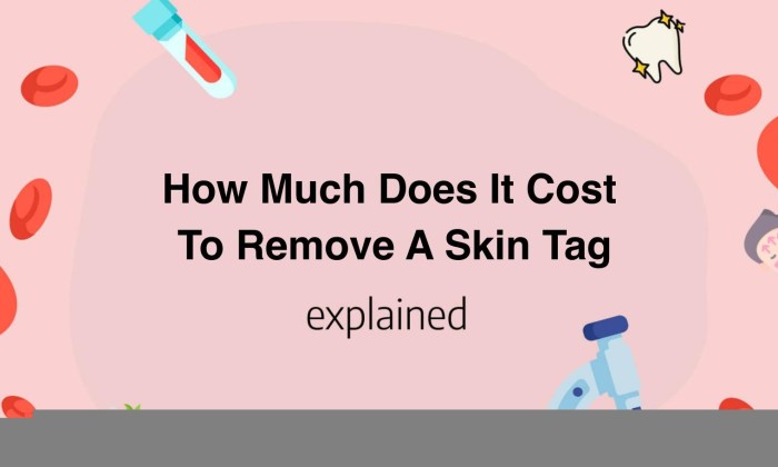 How A lot Does It Price to Take away a Pores and skin Tag? A Complete Information