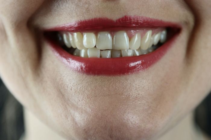 How one can Get Rid of Black Spots on Tooth A Complete Information
