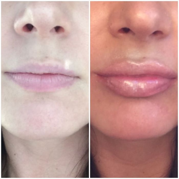 How Outdated for Lip Injections?  A Complete Information