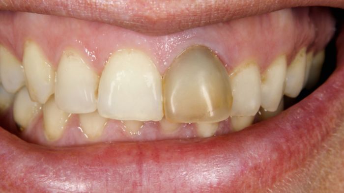 How to remove black stains on baby teeth