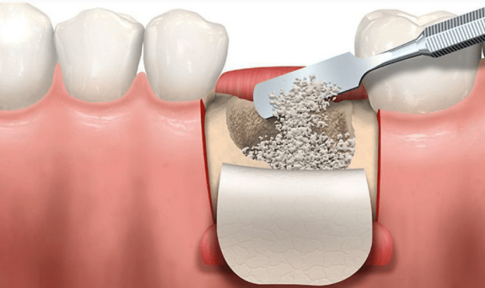 How long do bone grafts take to heal