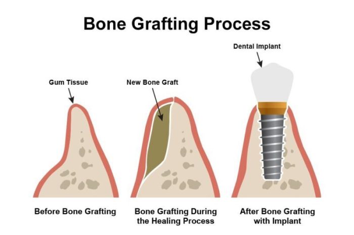 Graft hurt grafts recover How long does it take a bone graft to heal