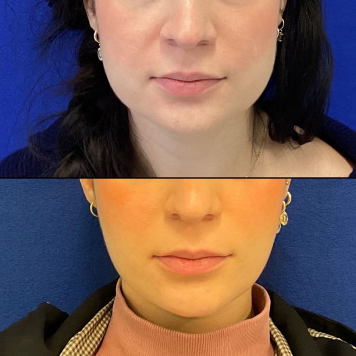 How Lengthy for Masseter Botox to Work? Your Information