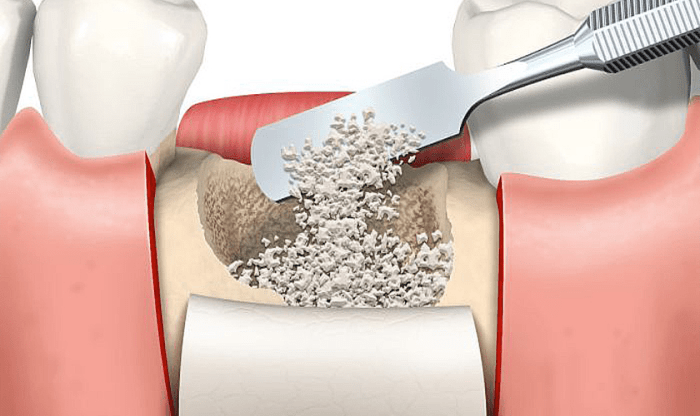 Graft bone heal typically does dental How long does it take a bone graft to heal