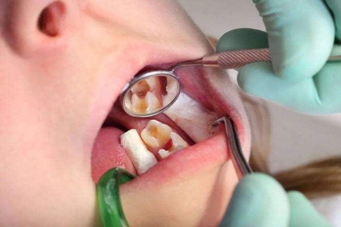Cavity fillings How long does it take to fill 2 cavities