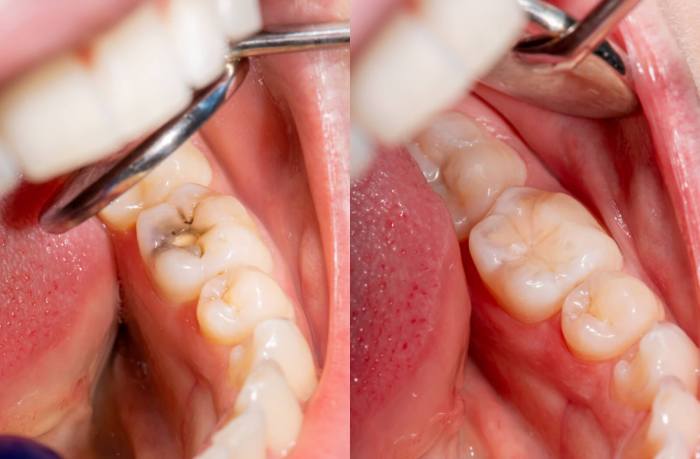 How long does it take for filler to settle