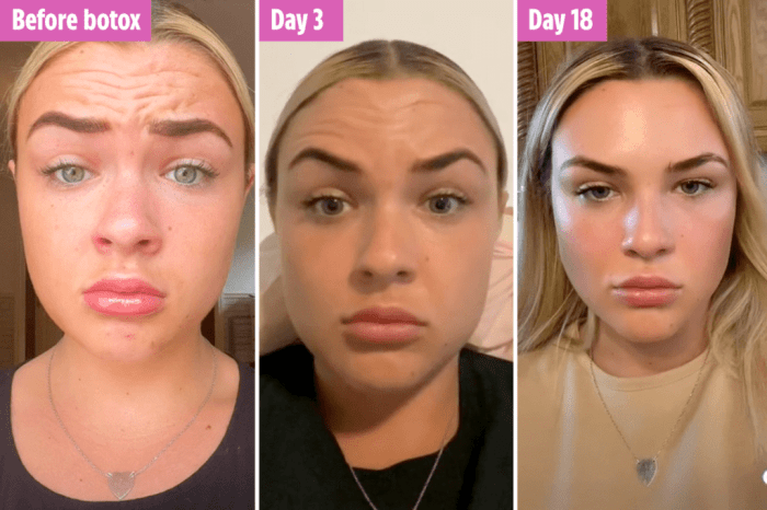 How Lengthy Does Masseter Botox Take to Work? Unveiled