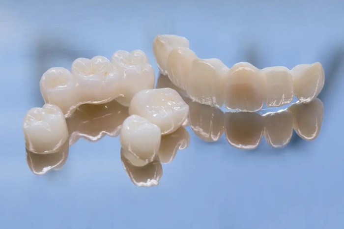 How A lot Does It Value to Take away a Dental Bridge?