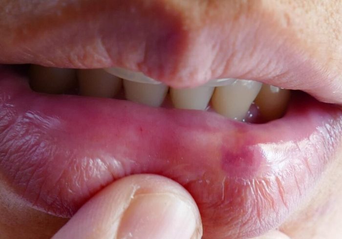 The right way to Remedy a Lip Chew A Complete Information