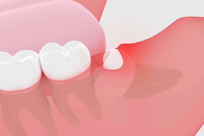 Knowledge Tooth Extraction Swelling A Vital Information