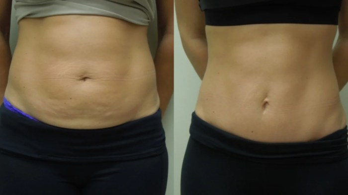 Tummy tuck surgery differ How to get a free tummy tuck
