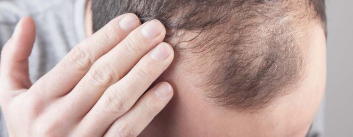 How to stop mounjaro hair loss