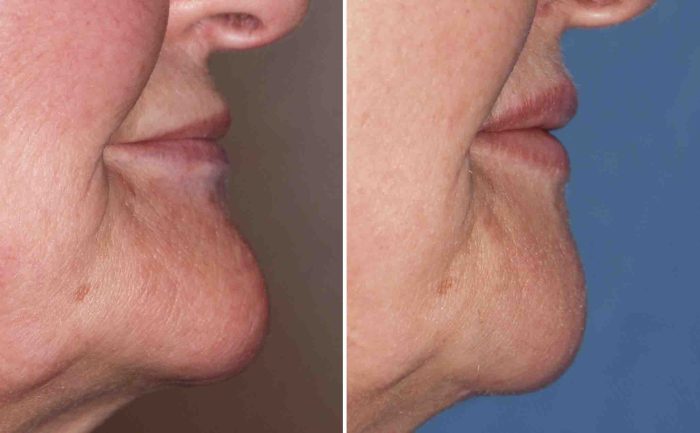 How you can Make Chin Smaller Your Full Information