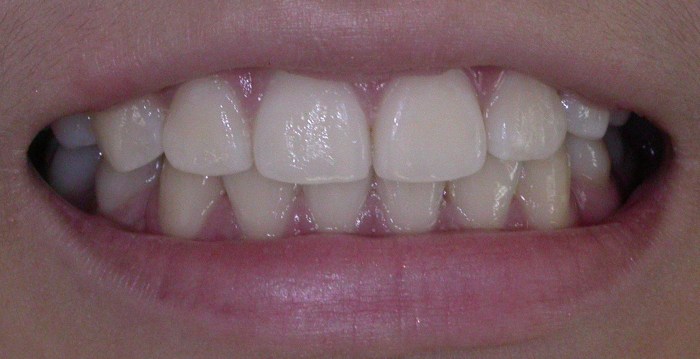 Gagging stop How to stop shock in mouth between fillings