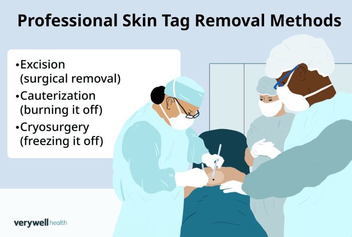 How much does it cost to get skin tags removed