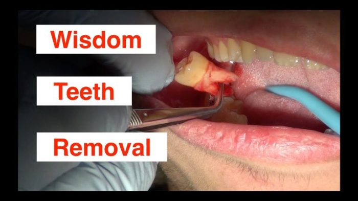 The way to Forestall Swelling After Knowledge Enamel Removing