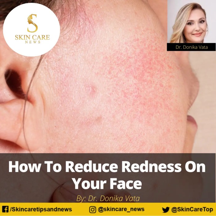 How to eliminate redness from face