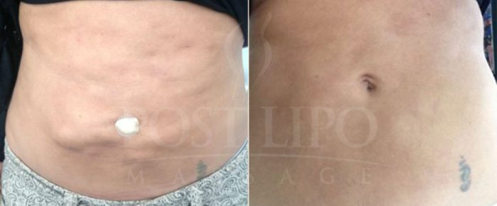How to massage hard spots after lipo