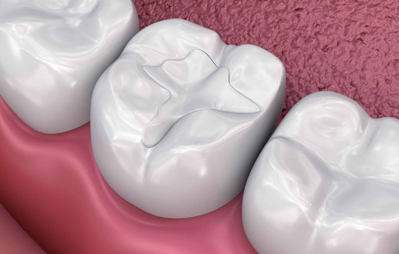 How long does it take to fill two cavities