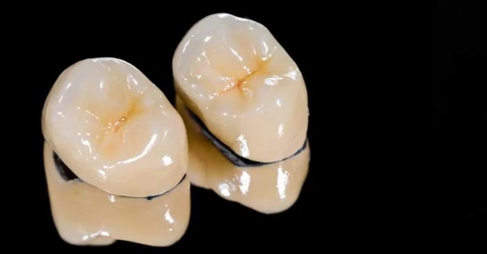 The way to Clear Out Previous Crown Fillings