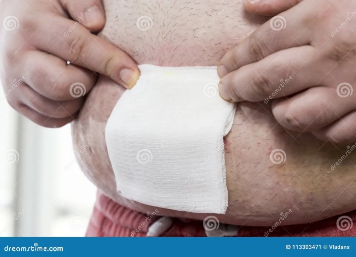 How you can Take away Caught Gauze on Wounds