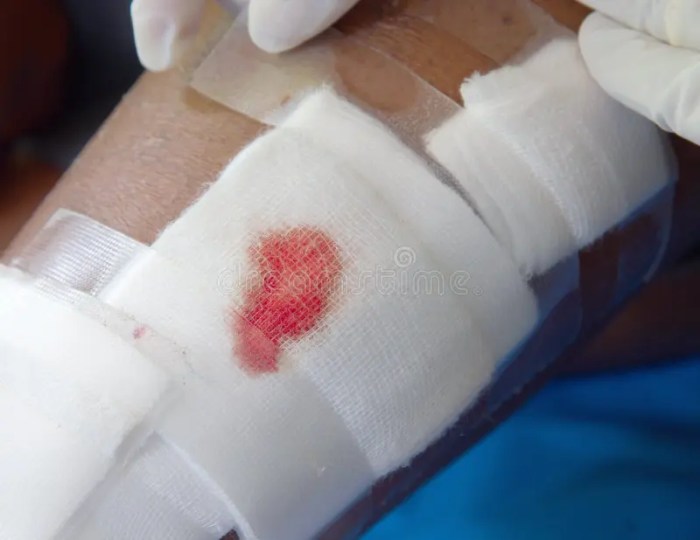 How to get gauze unstuck from a wound