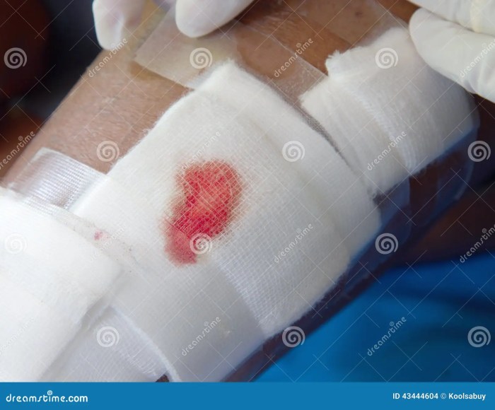Eradicating Caught Gauze A Complete Information