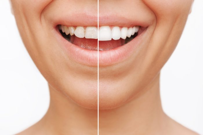 How long does it take to get veneers