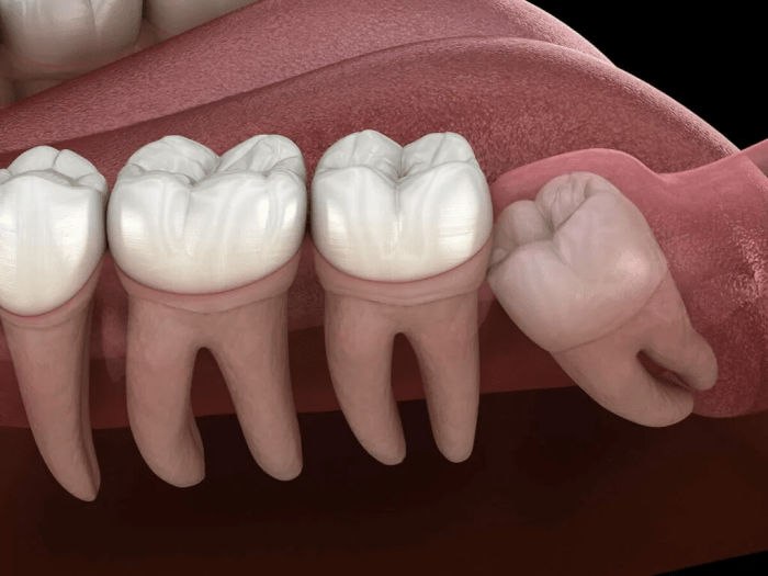 How long do wisdom teeth stitches take to dissolve