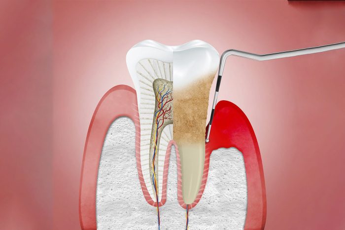 Residence Root Canal Ache Aid