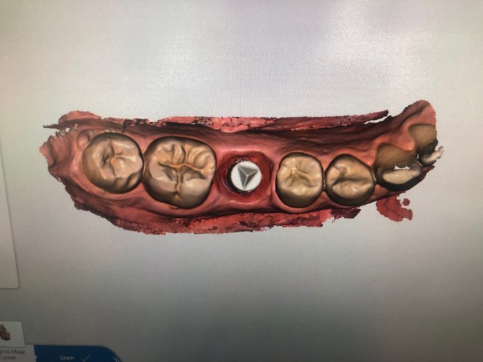 How long for implant to heal before crown