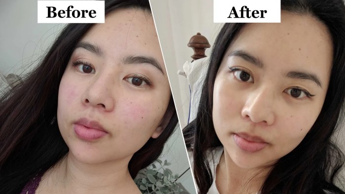 Masseter botox reduction tasteful How long does masseter botox take to work