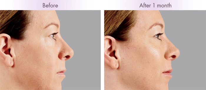 How Lengthy Does It Take for Fillers to Settle?